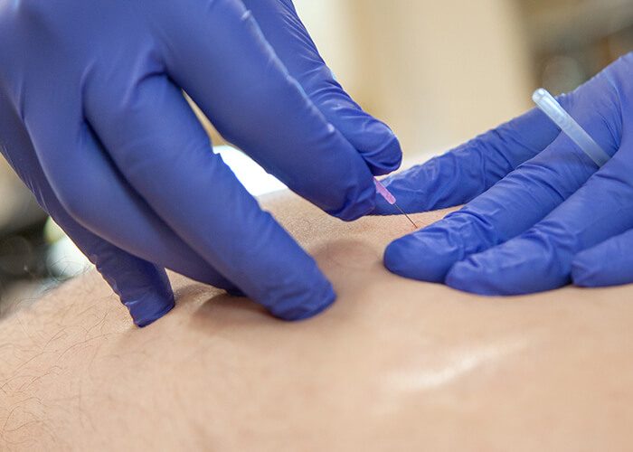 Dry needling